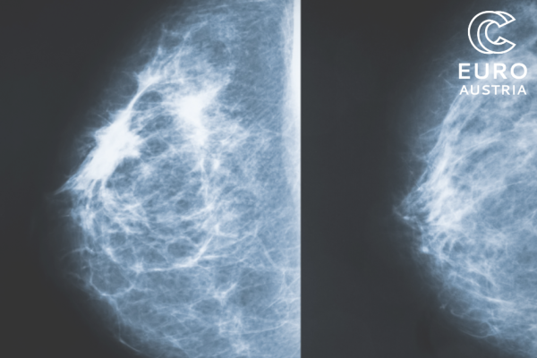 The pictures contains of 2 mamographies: the left image shows breast cancer, the right healthy tissue.